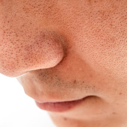 Problembehandlung Mitesser