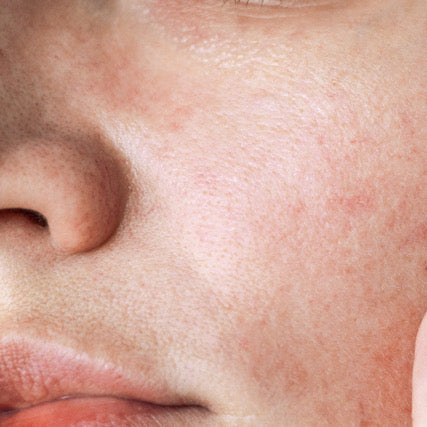 Problembehandlung fettige Haut