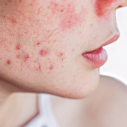 Problembehandlung Akne