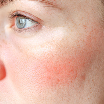 Problembehandlung Rötungen